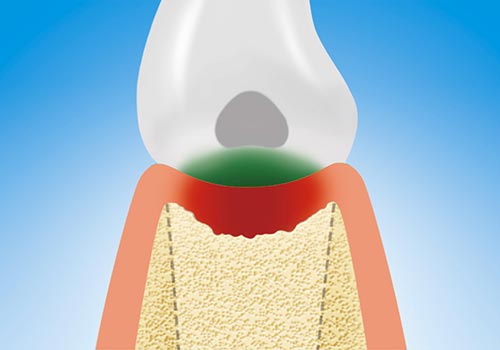 Bakterien unterm Zahn führen zum Knochenabbau, auch Parodontitis genannt.