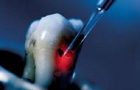 Beschädigter Zahn wird während der parodontologische Behandlung mit Laser behandelt.