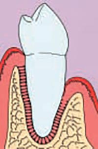 Zahnhals ist vor der Parodontologie einseitig nicht von Knochen und Zahnfleisch umschlossen.
