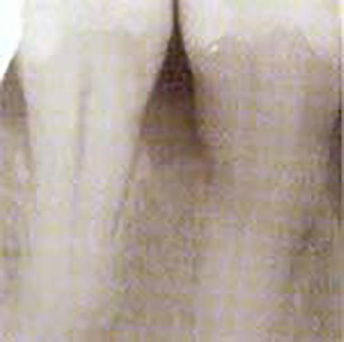 Röntgenbild zeigt verheilte Zahnwurzel nach der parodontologischen Behandlung