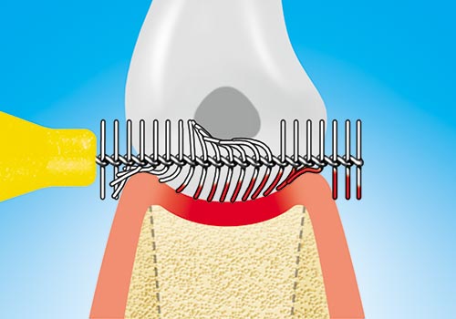 Querschnitt von Kiefer und Zahn, deren Zwischenraum von der Brüste perfekt gereinigt werden kann.