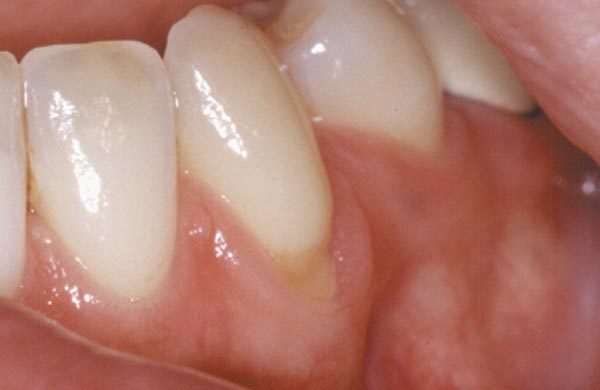 Effekte beim Zähneputzen