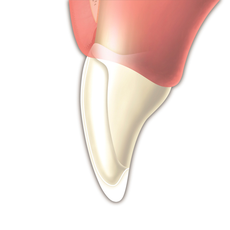 Die unsichtbare Keramikschale wird auf den Zahn aufgeklebt wodurch der Zahn voller ist.