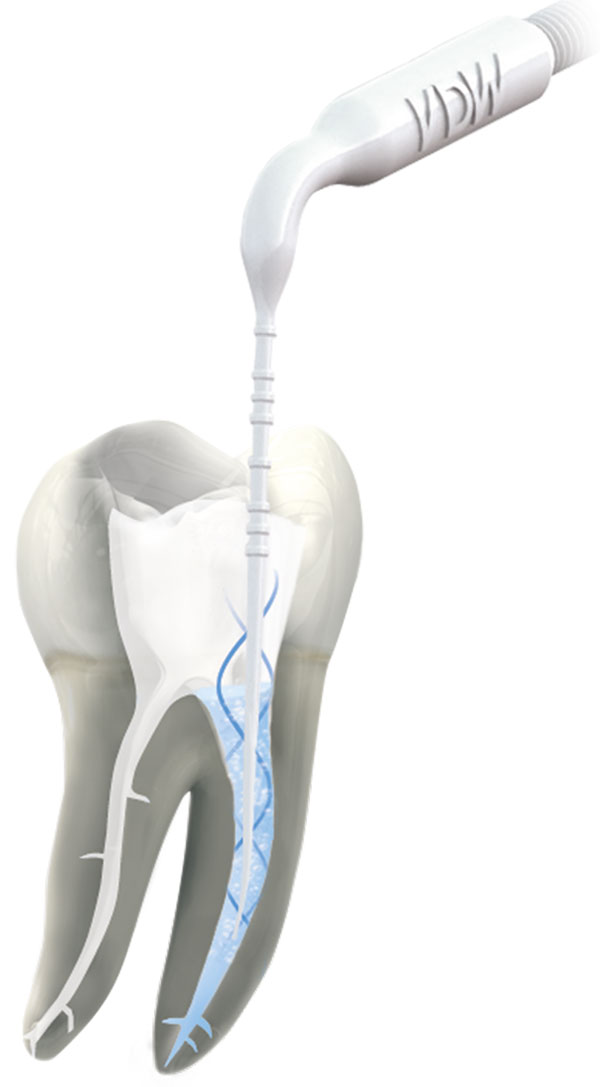 Zur Reinigung der ganzen Zahnwurzel wird die Spüllösung durch Ultraschall aktiviert
