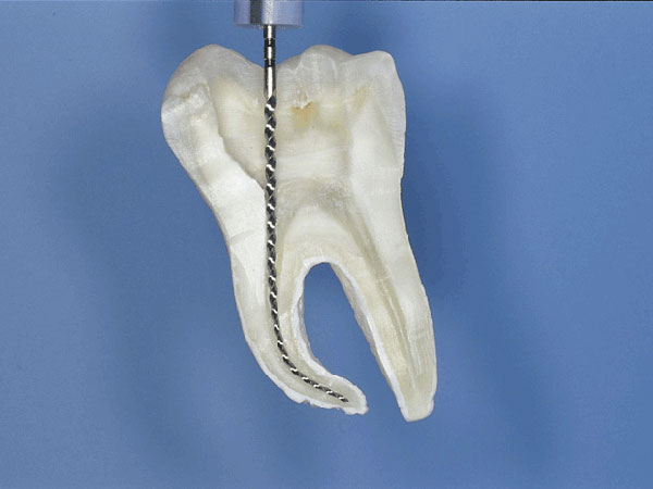 Hoch flexible Wurzelkanalfeile reicht bis zum tiefsten Punkt der Zahnwurzel
